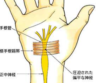 手根管症候群（Carpal Tunnel Syndrome：CTS）のアイキャッチ画像