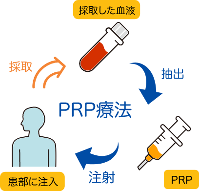 PRP療法とは