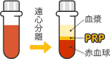 【PRPの抽出】